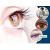 Isotina 6x MIGLIORI colliri cataratta glaucoma, non carnosina (NAC), può cataratta C