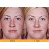KOZICARE 2X KOJIC ACID Skin Whitening Lightening Serum Ultra Brightening Crema...