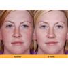 KOZICARE 2X KOJIC ACID Skin Whitening Lightening Serum Ultra Brightening Crema Macchie...