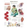 3B Scientific lehrtafek ipertensione, 1