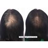HairMax LaserBand Dispositivo laser crescita capelli