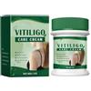 GNAUMORE Crema al vitiligo, crema per la cura della pelle del vitiligo, creme per la cura del vitiligo, rimuove le macchie bianche, 1 pezzo